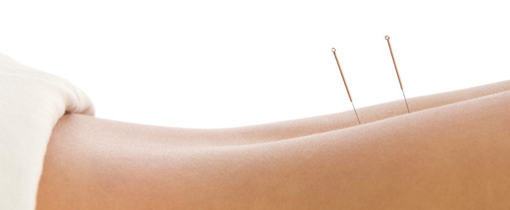 The best acupuncturists in Sydney, acupuncture needles at west street wellbeing